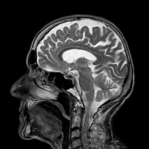 Concussion Evaluation and Treatment Toledo OH