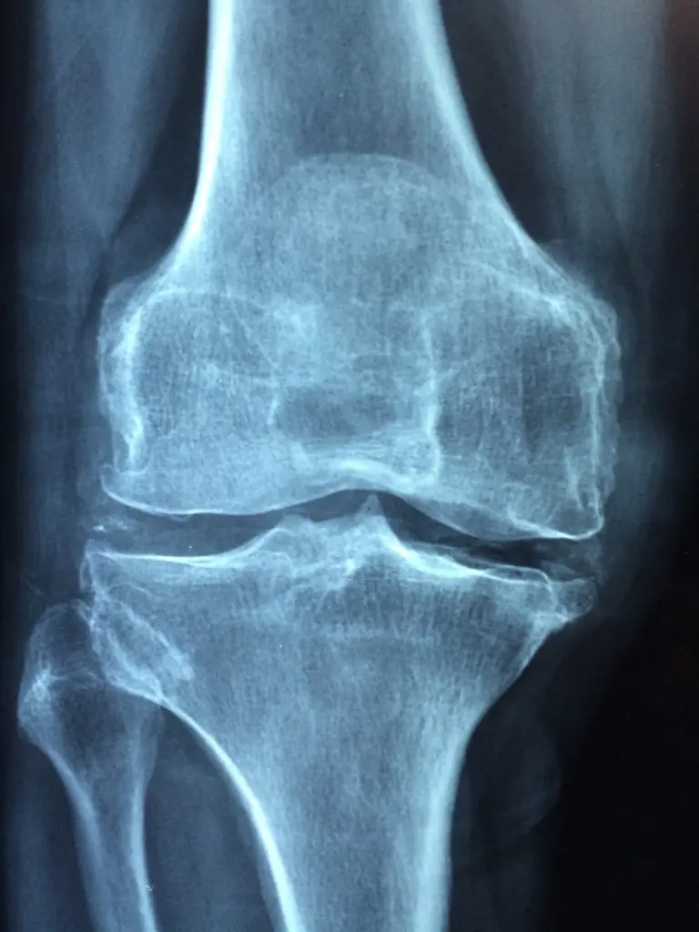 arthritis in knee doe not help knee pain relief