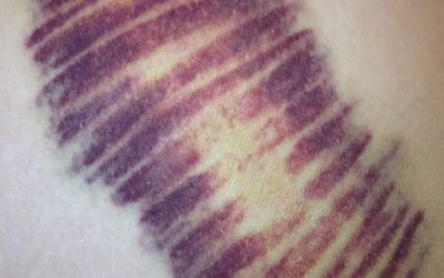 Kinesio Tape Drains Bruising