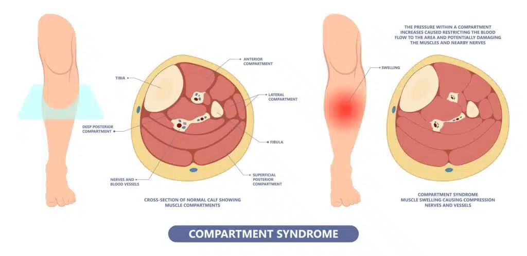 compartment syndrome anatomy