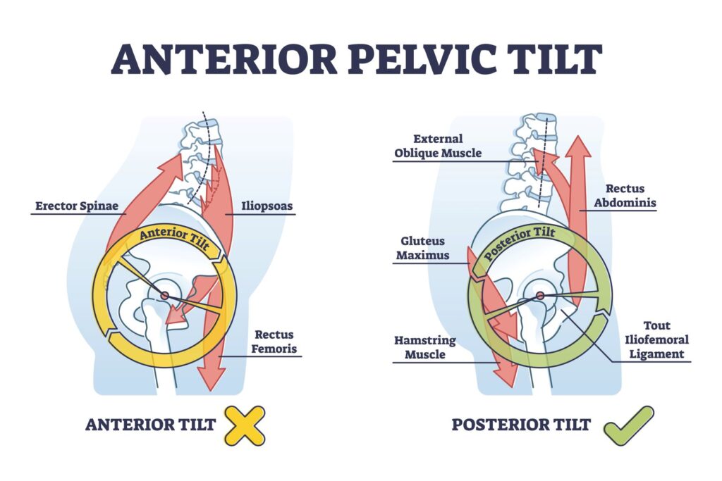 Anterior Pelvic Tilt associated with lower crossed syndrome