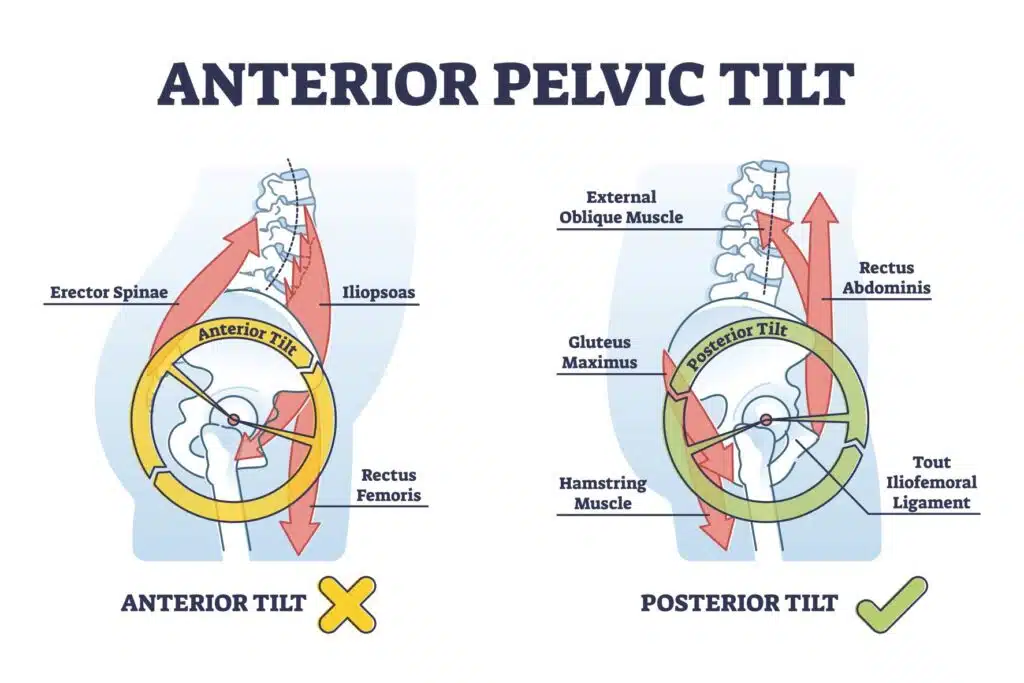 Anterior Pelvic Tilt associated with lower crossed syndrome