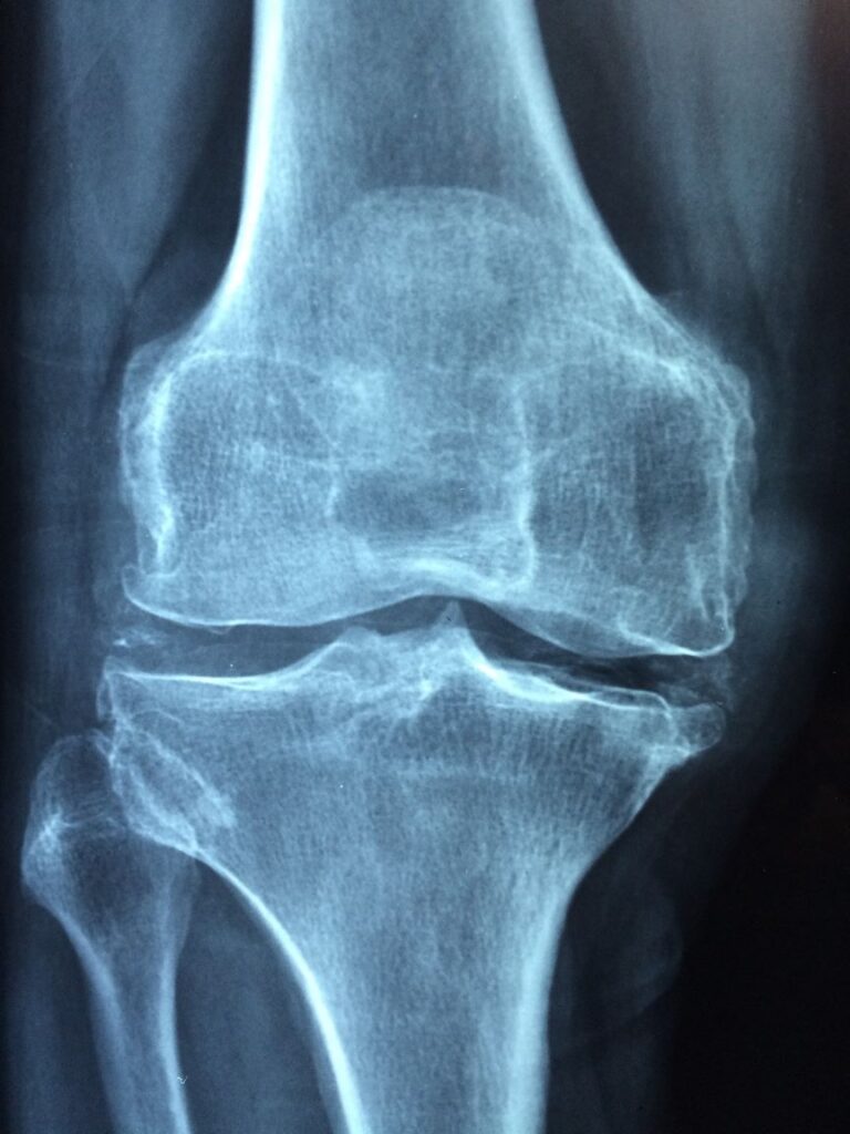 knee osteoarthritis x-ray