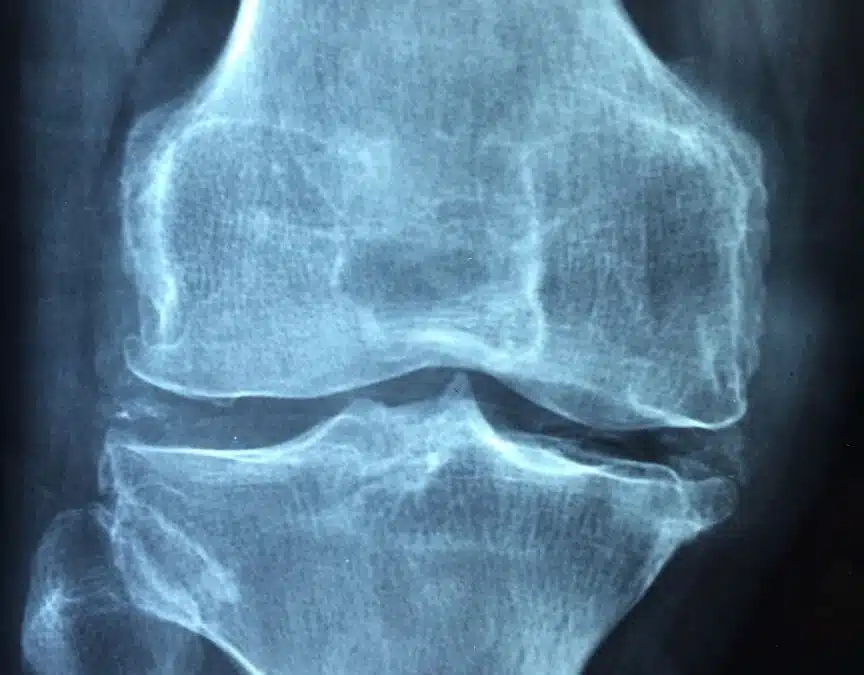 Knee Osteoarthritis: What You Need to Know