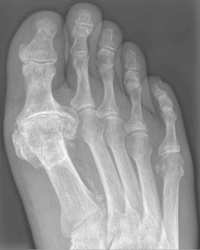 X-ray of a foot with Hallux rigidus