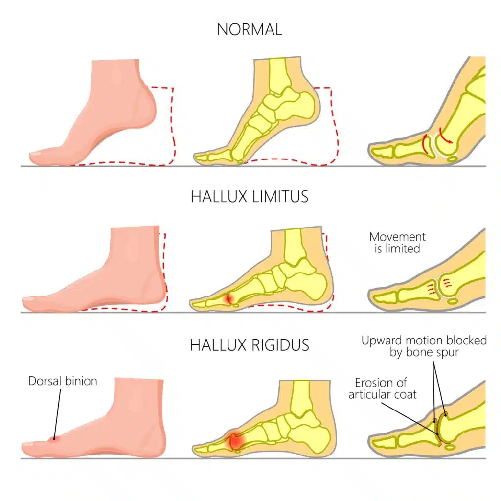 Illustration of feet with examples of hallux rigidus and hallux limitus