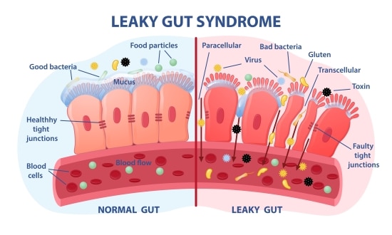 leaky gut syndrome worsens chronic inflammation