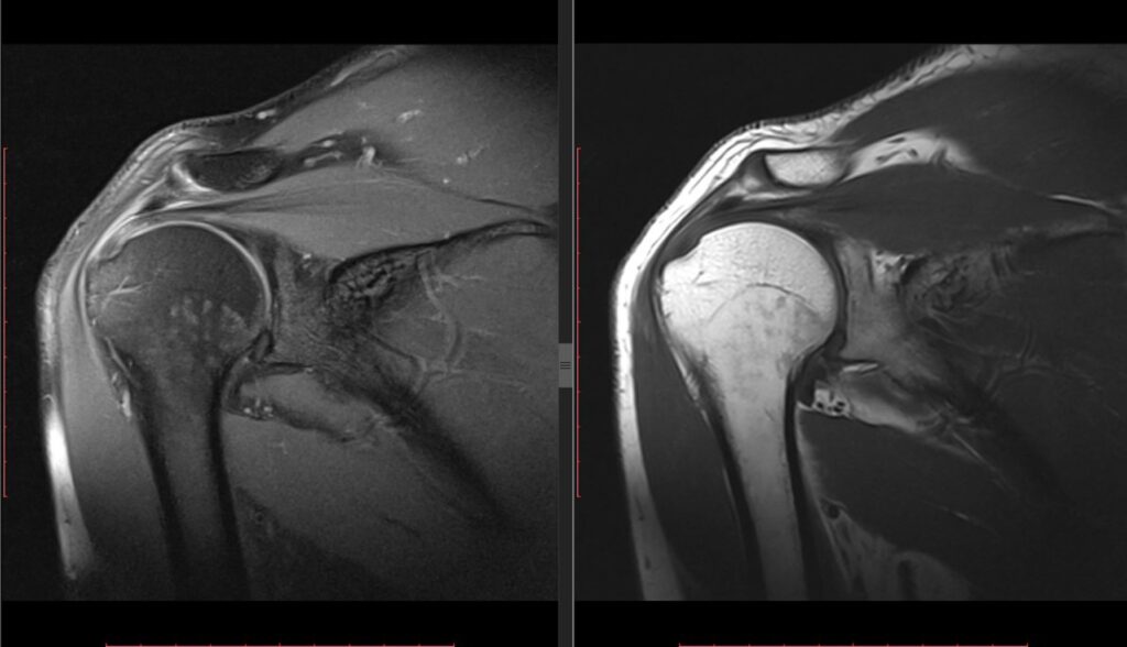 shoulder MRI for pain