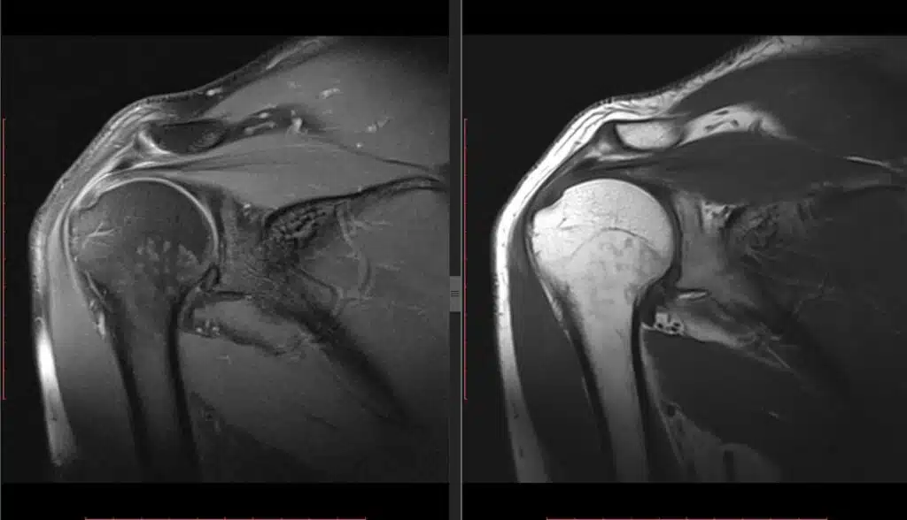 shoulder MRI for pain