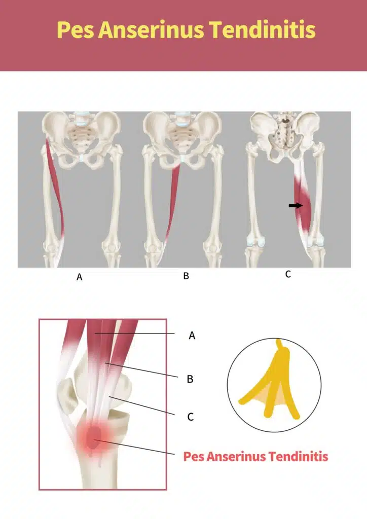 pes anserine bursitis is one type of possible bursitis in the knee
