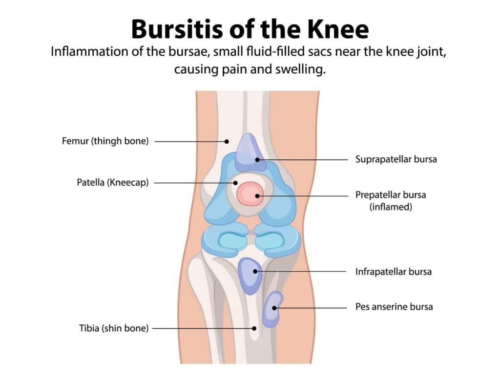 pes anserine bursitis is one type of possible bursitis in the knee