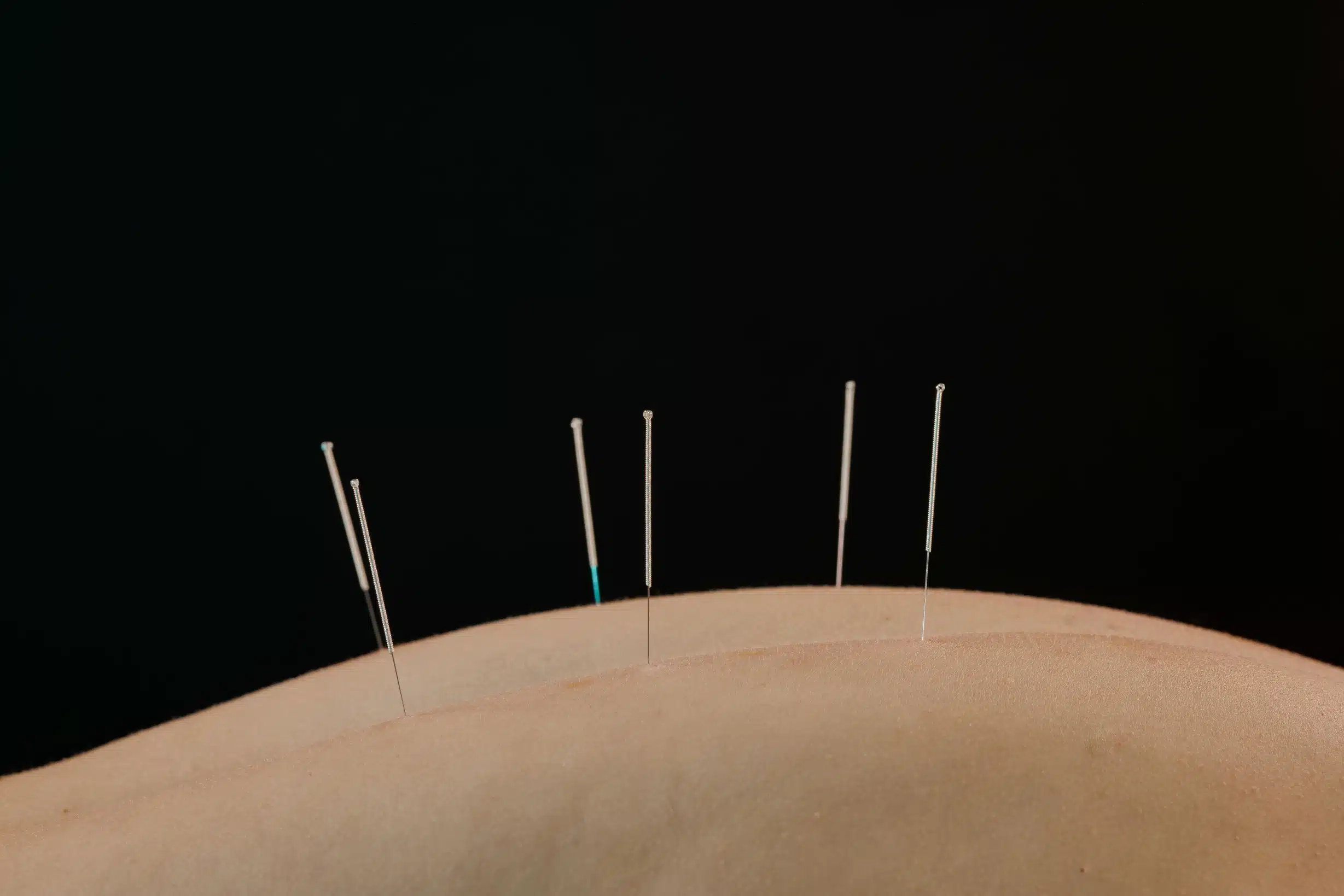 Dry Needling for back pain