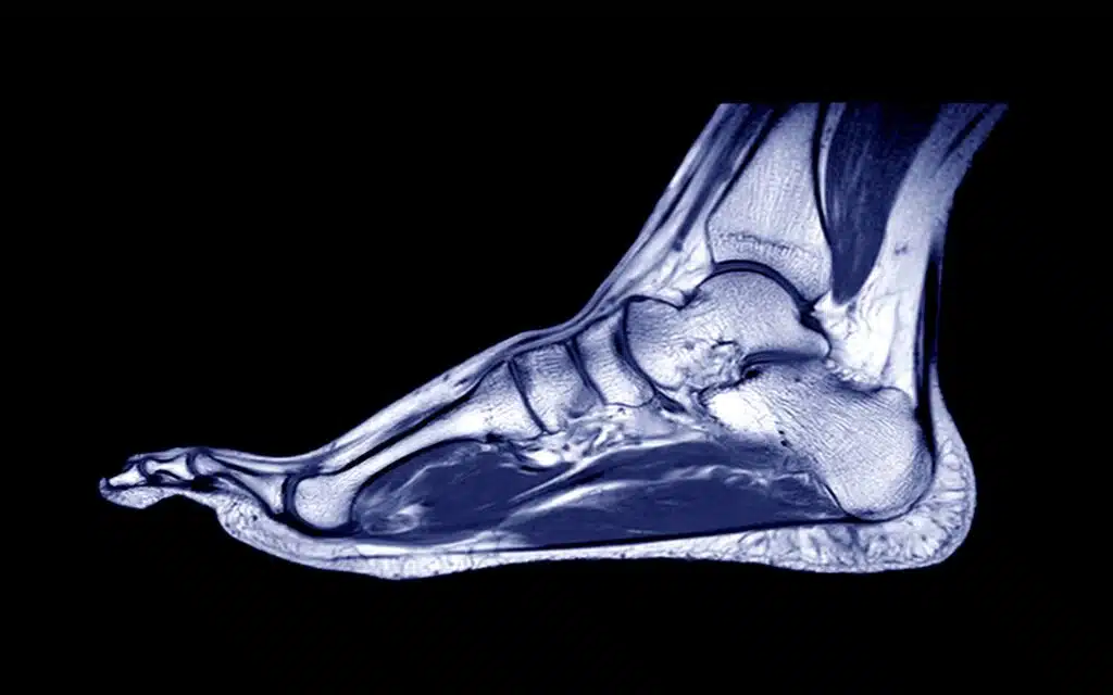 Foot & Ankle MRI can show the foot tripod