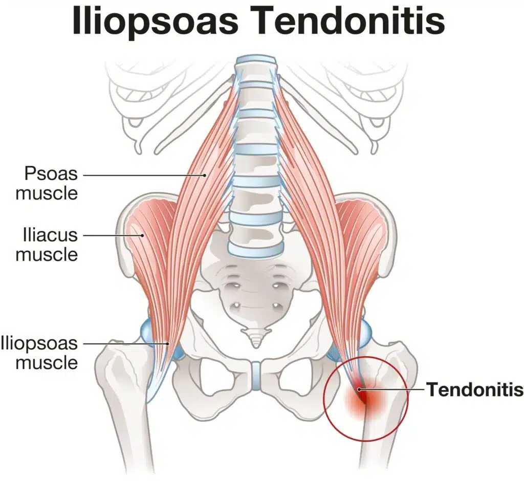 psoas tendonitis